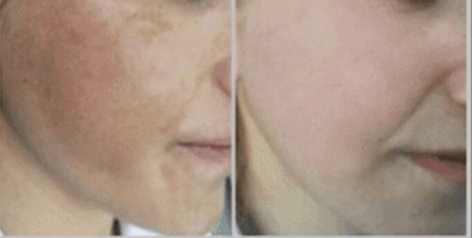 Nouvaderm for hyperpigmentation and texture